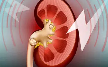 برای سلامت کلیه ها در ایام رمضان این کار را بکنید!