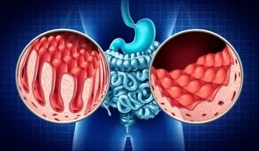 بیماری سلیاک؛ اختلال خودایمنی که سیستم گوارش را تهدید می‌کند