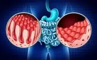بیماری سلیاک؛ اختلال خودایمنی که سیستم گوارش را تهدید می‌کند