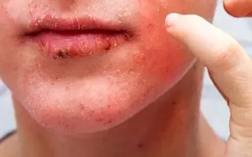 اگزما صورت و نکاتی که باید حتما بدانید!
