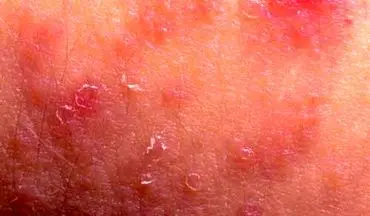 برجستگی‌های گنبدی پوست ارمغان تلخ بیماری‌های التهابی/ رسوب کلسیم در پوست را جدی بگیرید