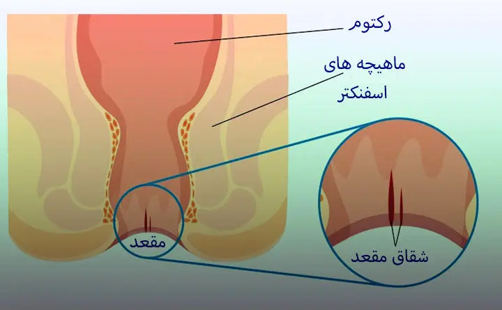 روش های درمان فیشر