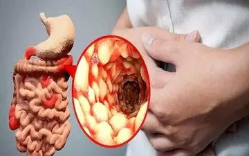  ویروس گوارشی جدید چه ویژگی دارد؟ | آیا ویروس گوارشی واگیردار است؟