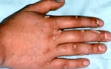 
آبله میمون زیر ذره بین سازمان جهانی بهداشت