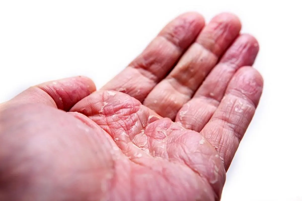 پوست پوست شدن انگشتان دست: چرا اتفاق می‌افتد و چه باید کرد؟
