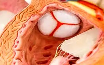 این علائم به شما می گویند به بیماری‌های دریچه‌ای قلب مبتلا هستید!