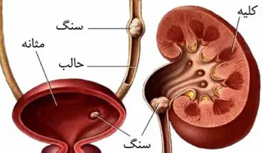 قوی ترین داروی گیاهی برای درمان سنگ کلیه!