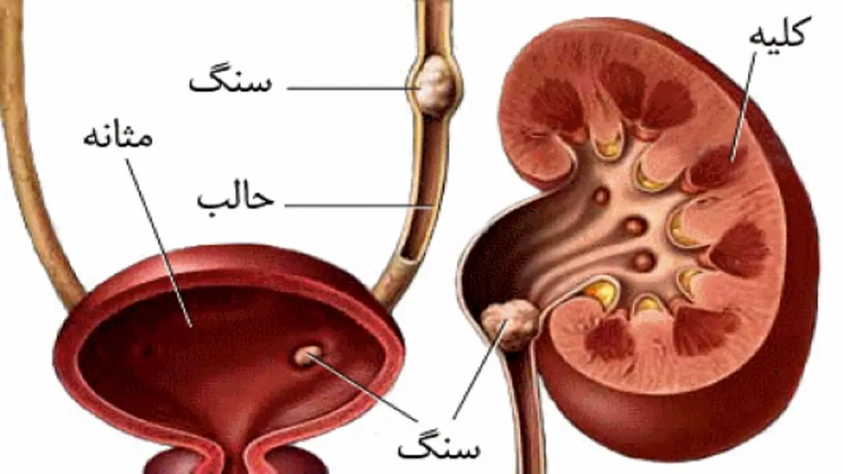 قوی ترین داروی گیاهی برای درمان سنگ کلیه!