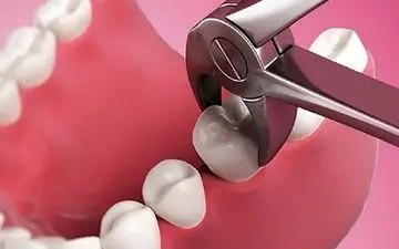 دندان عقل نهفته را حتما بکشید 