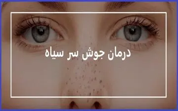 درمان جوش های سرسیاه