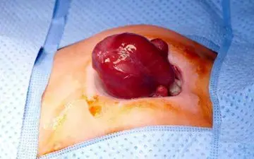 نجات نوزادی که قلبش بیرون بدنش بود + عکس