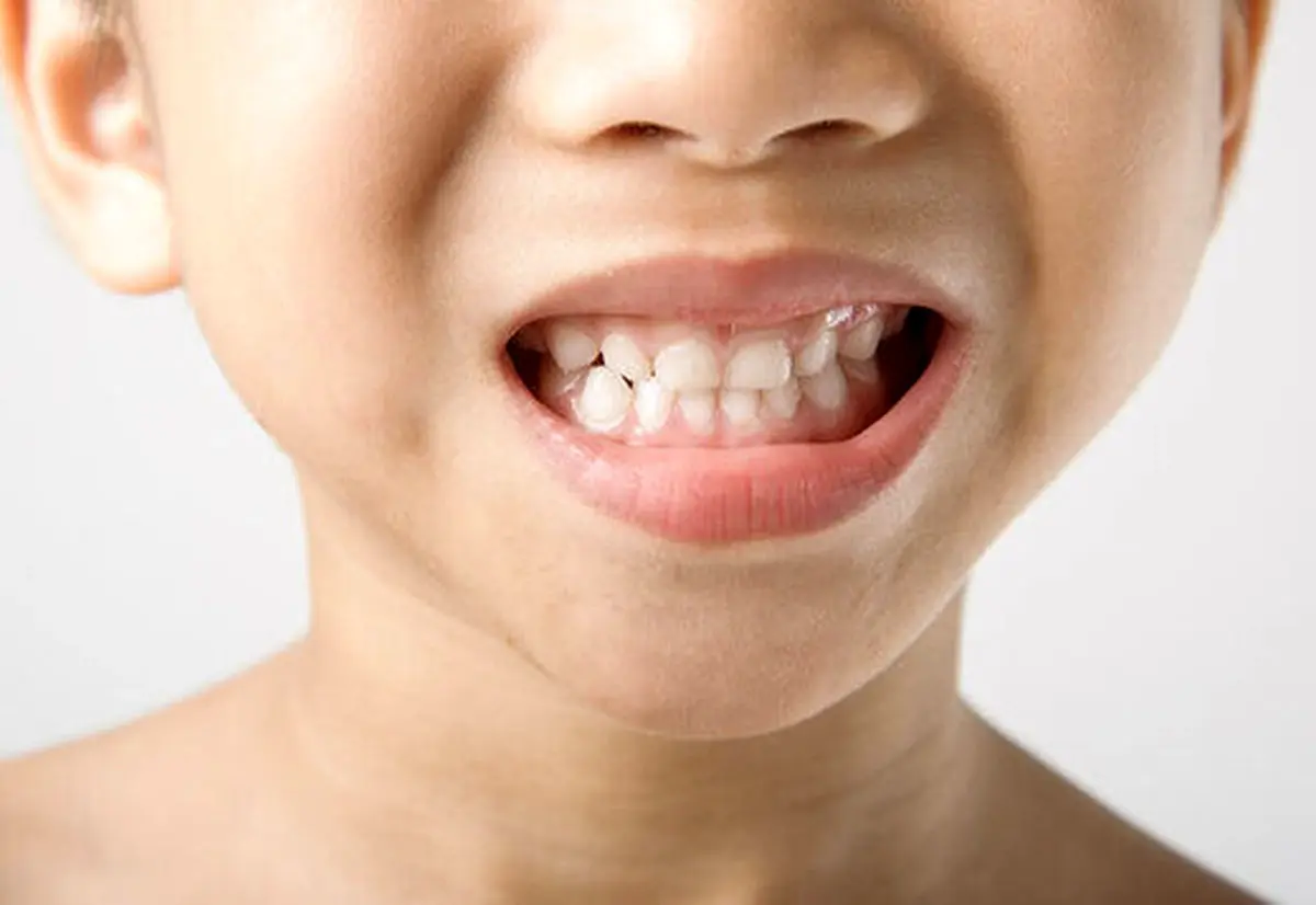 علت دندان قروچه در کودکان