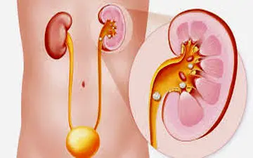 بهترین روش برای شکستن سنگ‌های کلیه بدون درد 