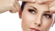 تفاوت اگزما با آکنه چیست؟