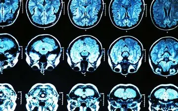 افزایش خطر ابتلا به کرونا با داشتن نوعی ژن معیوب مرتبط با زوال عقل