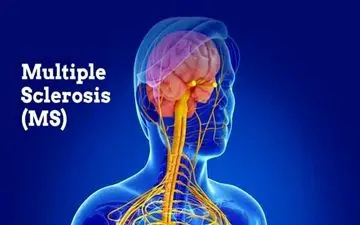 رنجی به نام "ام اس"