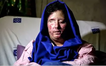 آخرین فرصت برای دیدن روشنی/ قربانی اسید پاشی های مشکوک اصفهان چه درخواستی دارد؟ 