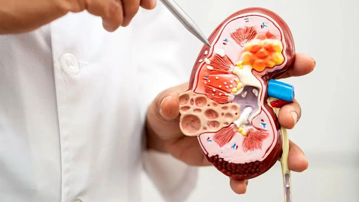 برای سلامت کلیه خود حتما این موارد را رعایت کنید!