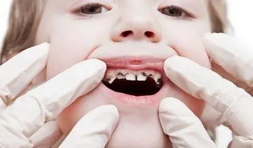 چرا پوسیدگی دندان در بین دانش‌آموزان رایج است؟

