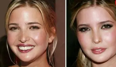 دختر ترامپ قبل و بعد از عمل زیبایی + عکس 