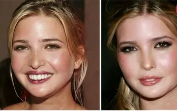 دختر ترامپ قبل و بعد از عمل زیبایی + عکس 