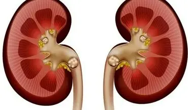 این افراد بشدت مستعد  ابتلا به سنگ کلیه هستند!