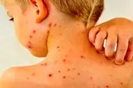 کاهش میزان واکسیناسیون آمار ابتلا به سرخک را افزایشی کرد