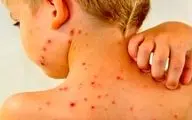 کاهش میزان واکسیناسیون آمار ابتلا به سرخک را افزایشی کرد