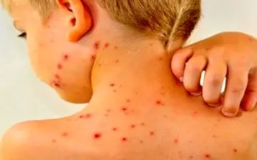 کاهش میزان واکسیناسیون آمار ابتلا به سرخک را افزایشی کرد