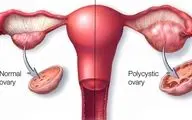 سندرم تخمدان پلی کیستیک؛ از تشخیص تا درمان