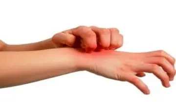 حساسیت غذایی ریسک ابتلا به این بیماری‌ها را افزایش می‌دهد