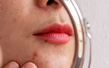 این کارها باعث تشدید جوش‌های صورت می‌شوند