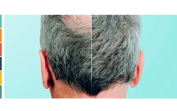 بعد کاشت مو چی بخوریم تا بهتر نتیجه میگیریم؟| تغذیه پس از کاشت موی سر + غذاهای ممنوعه