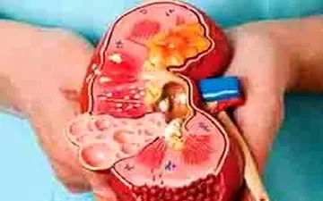 راه هایی برای پیشگیری از سنگ کلیه 