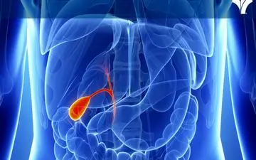 درمان خانگی سنگ کیسه صفرا