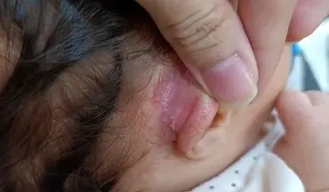 پشت گوش؛ محیطی مناسب برای رشد باکتری‌ ها