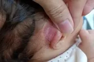 پشت گوش؛ محیطی مناسب برای رشد باکتری‌ ها