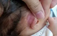 پشت گوش؛ محیطی مناسب برای رشد باکتری‌ ها