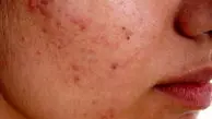 روش هایی جادویی برای درمان آکنه