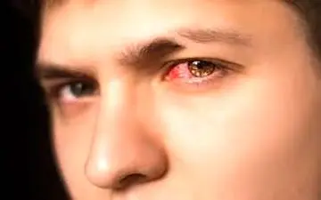 در مورد سرماخوردگی چشمی چه میدانید؟