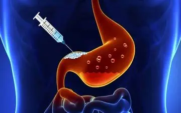 در مورد اثرات  بوتاکس معده چه می دانید؟