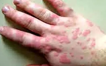 مهمترین علائم «پوستی» ابتلا به کرونا چیست؟
