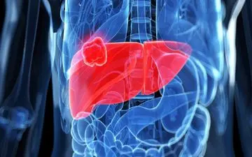 مهم‌ترین علت بروز سرطان کبد را بشناسید 