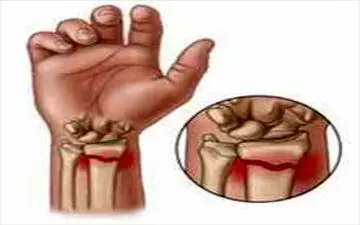 تاثیر مستقیم یائسگی بر استخوان