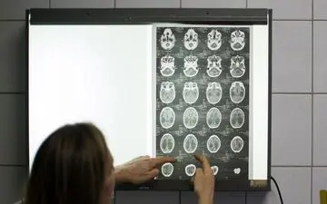 
کرونای خفیف هم به مغز رحم نمی‌کند!