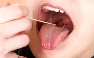 نقش لوزه‌ها در سیستم ایمنی بدن