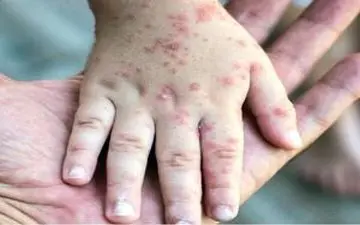 شناسایی ۷۰ مبتلا به سرخک در هرمزگان