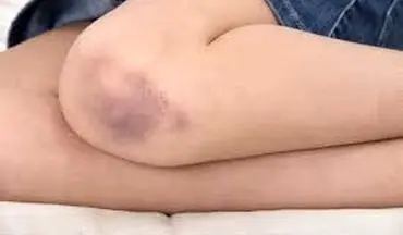 در مورد خونریزی داخل مفصل چه می دانید؟