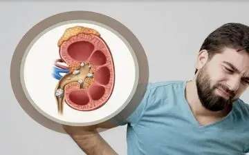 دشمن پنهان کلیه‌ها را بشناسید