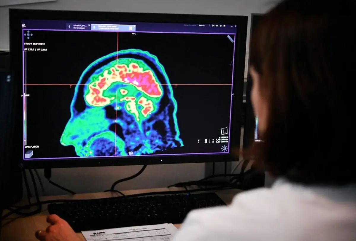 تشخیص تومور مغزی با هوش مصنوعی| هوش مصنوعی به سرعت تشخیص می‌دهد